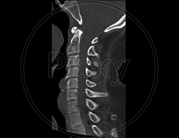 Computed Tomography examination of the  Cervical spine ( CT CS) sagittal in cine mode