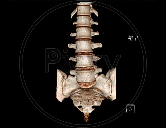 Computed Tomography Volume Rendering examination of the  Lumbosacral spine ( CT VR LSS)