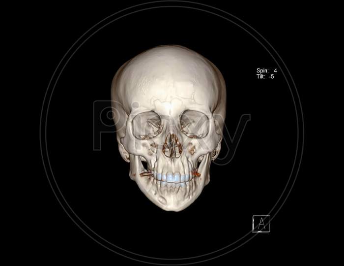 Computed Tomography of the  Skull (facial bones) in 3D