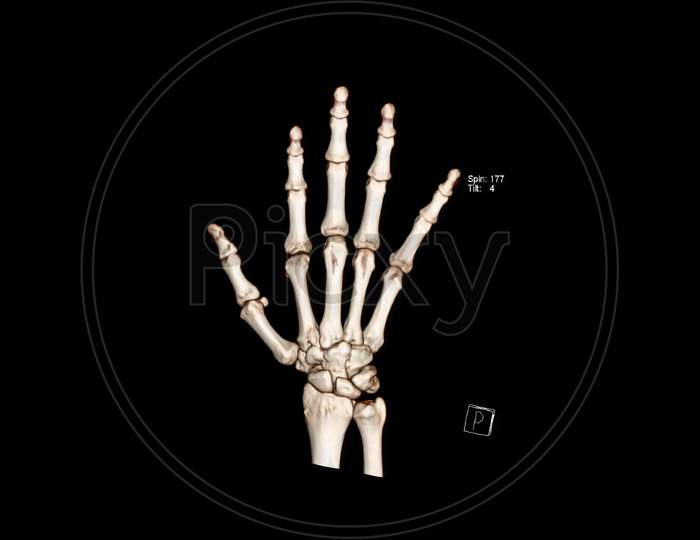 Computed Tomography Volume Rendering examination of the hand showing normal anatomy