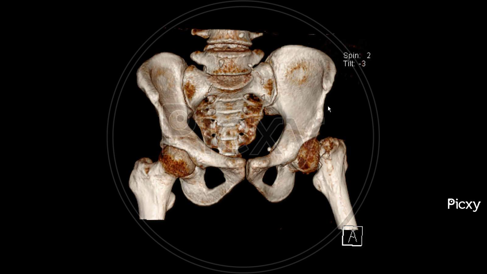 Computed Tomography Volume Rendering examination of the  pelvis showing left femur neck fracture