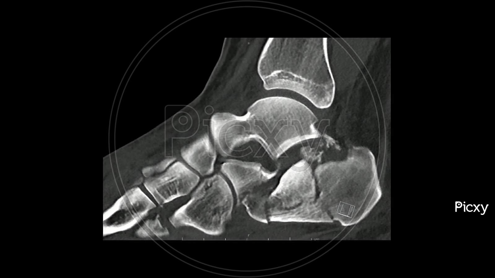 Computed Tomography  of the  foot in sagittal plane showing fracture of  calcaneum/ heel bone