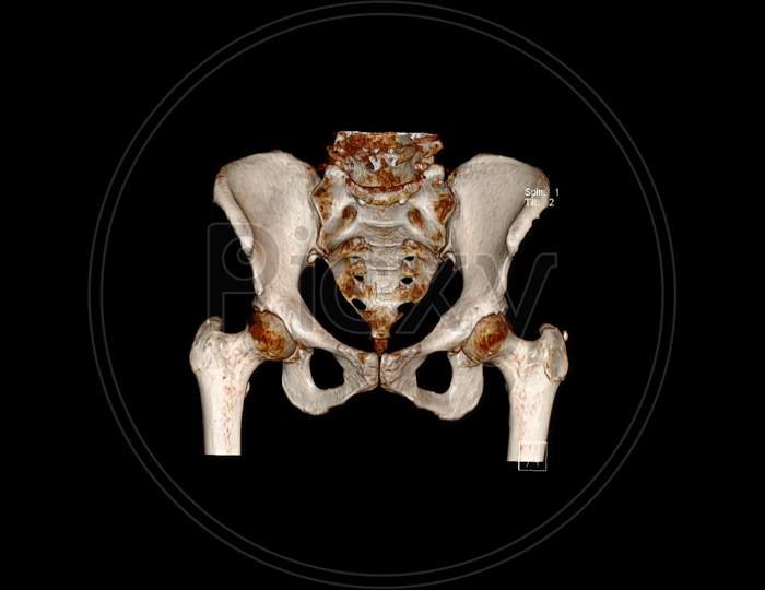 Computed Tomography Volume Rendering examination of the  pelvic bones