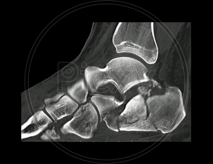 Computed Tomography  of the  foot in sagittal plane showing fracture of  calcaneum/ heel bone