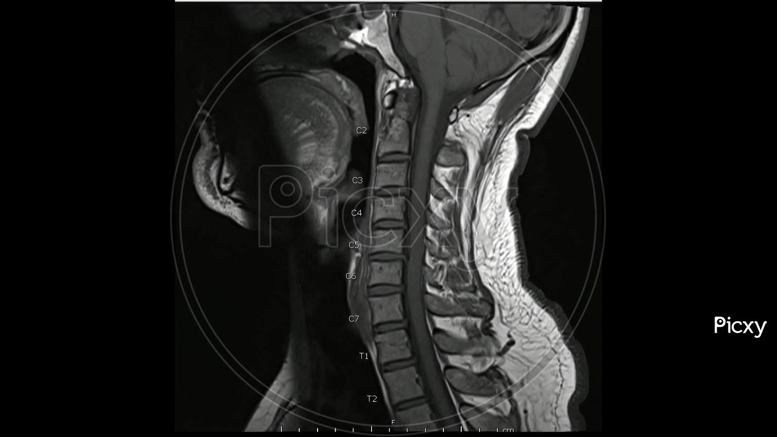 Image Of Magnetic Resonance Images Of Cervical Spine Sagittal T1