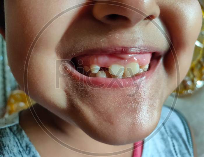 Close Up Or Primary Teeth Of Children Or Girl.