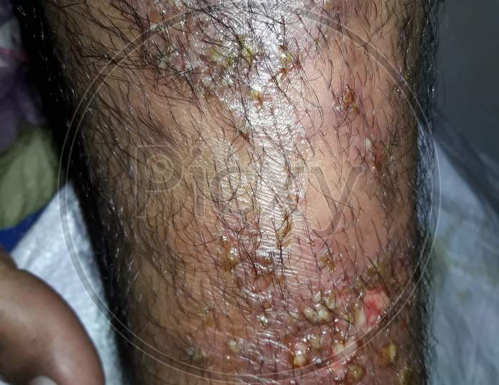 Very  painful  skin  disease  infection  on  men's  left  side  leg.