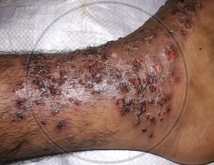 Very  painful  skin  disease  infection  on  men's  left  side  leg.
