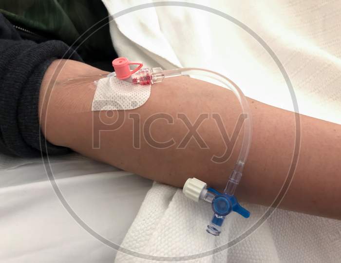 Cannula Inserted In Hand