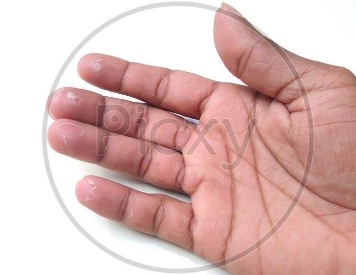 skin peeling on fingertips