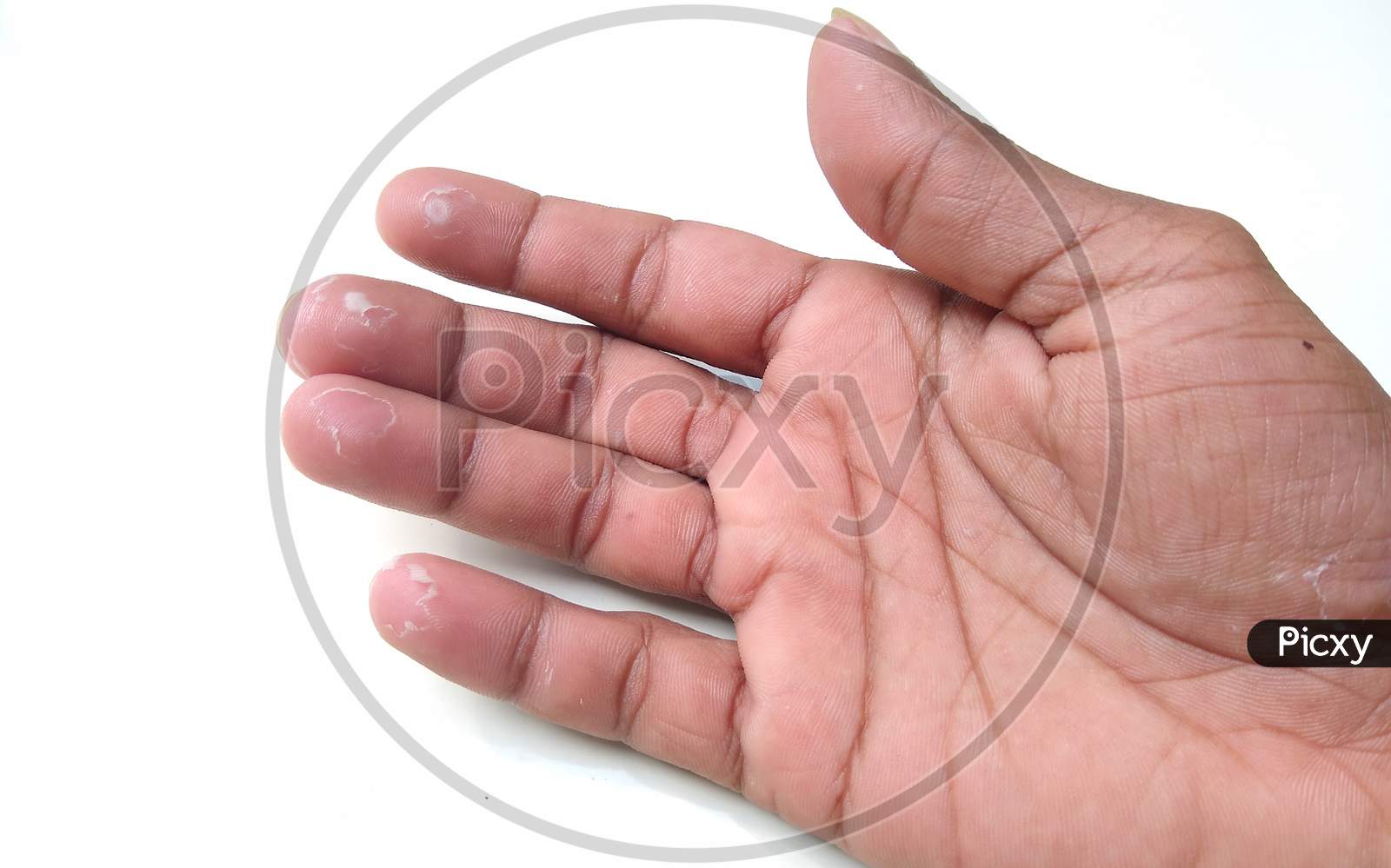 skin peeling on fingertips