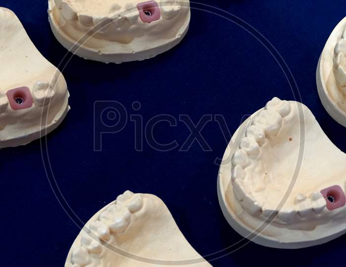 View Of Prosthetic Denture Or Implant In Dental Laboratory Or Clinic