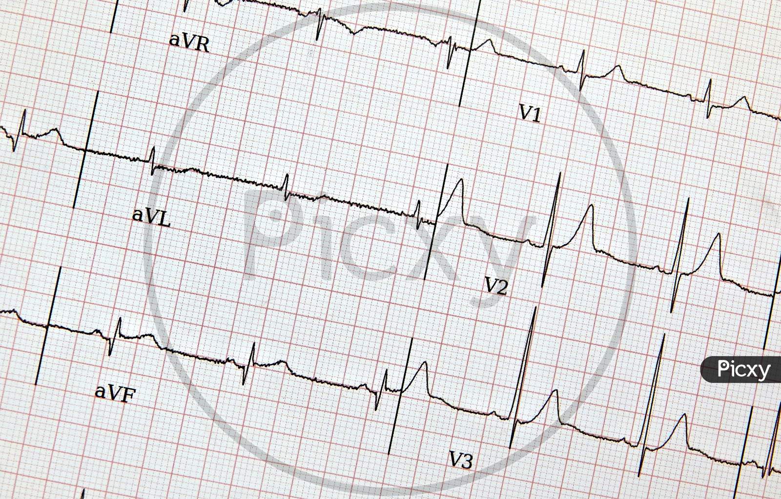 View Of Ecg Or Heart Beat Or Health Details Print Out Report Of Patient