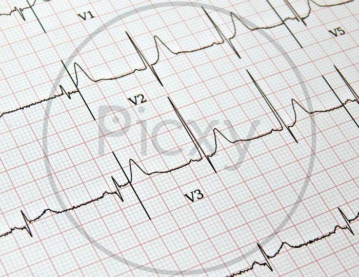 View Of Ecg Or Heart Beat Or Health Details Print Out Report Of Patient