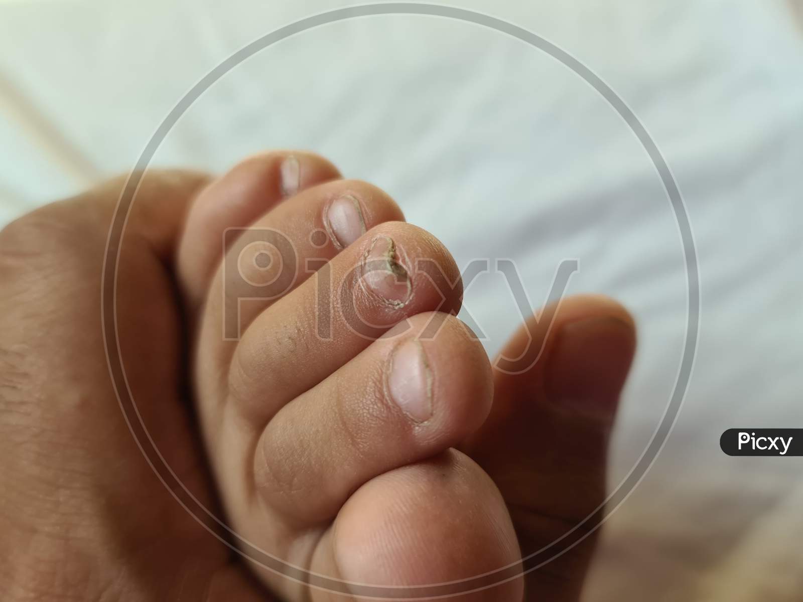Image of Foot With Damaged Nails Dorsal, Callus, Corn, Because Of