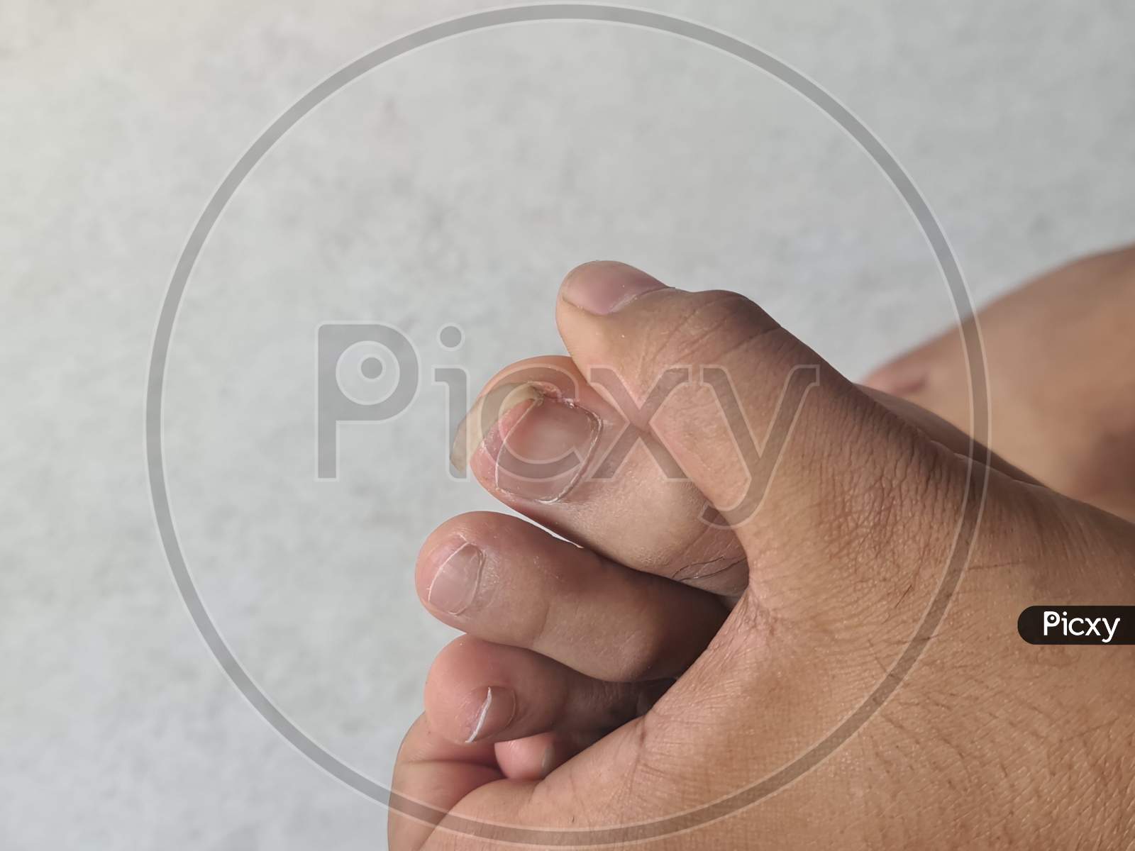 Image of Foot With Damaged Nails Dorsal, Callus, Corn, Because Of