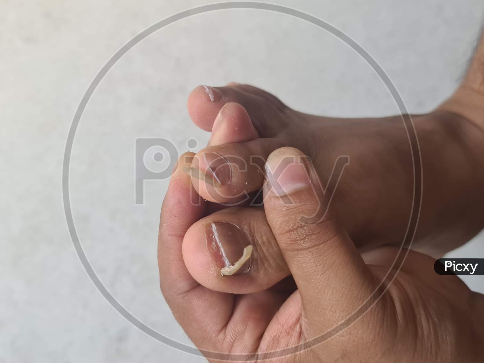 Image of Foot With Damaged Nails Dorsal, Callus, Corn, Because Of FungusTX789145Picxy