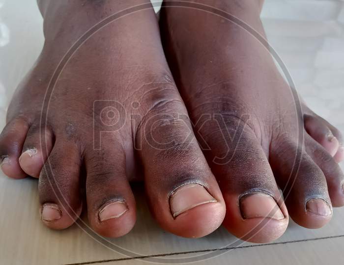 Toes are different, not normal