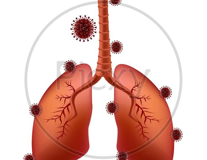 Corona Virus Covid-19 Adheres To The Lungs Of The Lung Patient