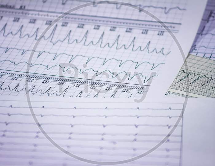 Tracing Of Electrocardiograms On Graph Paper. Records Of Heart Activity. Heartbeat With Arrhythmia. Selective Focus