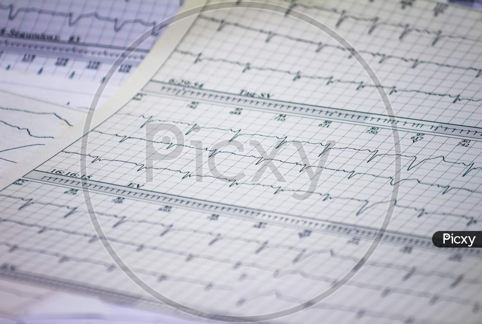 Tracing Of Electrocardiograms On Graph Paper. Records Of Heart Activity. Heartbeat With Arrhythmia. Selective Focus