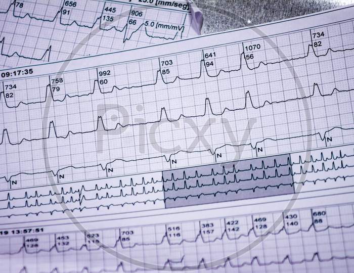 Electrocardiogram Strips With Cardiac Arrhythmias. Acute Myocardial Infarction. Selective Focus On Some Beats. Free Space To Write.
