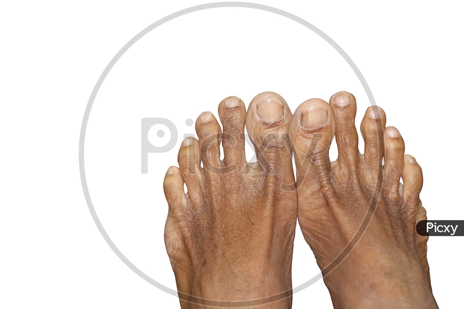 White flaky skin on on sale feet