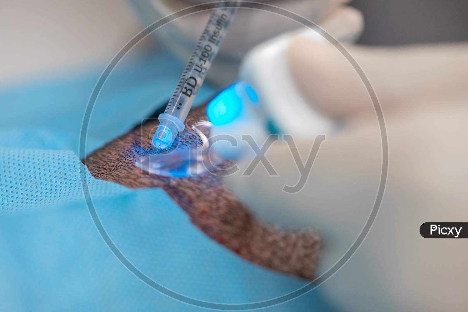 Hair Implantation Process, Injecting Anestesia In Scalp