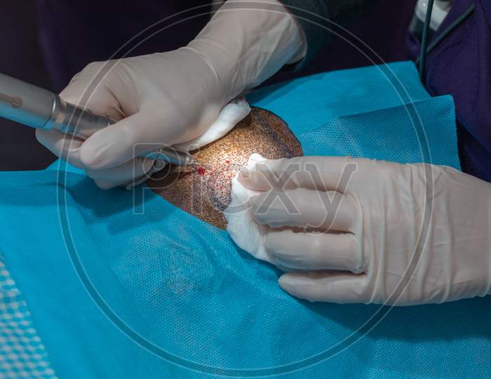 Hair Implant Process, Collecting Hair Plasma For Implanting Process