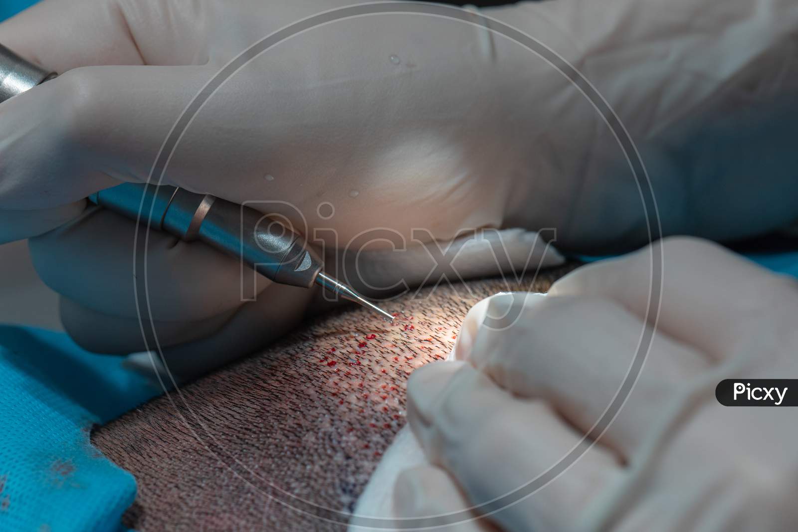 Hair Implant Process, Collecting Hair Plasma For Implanting Process