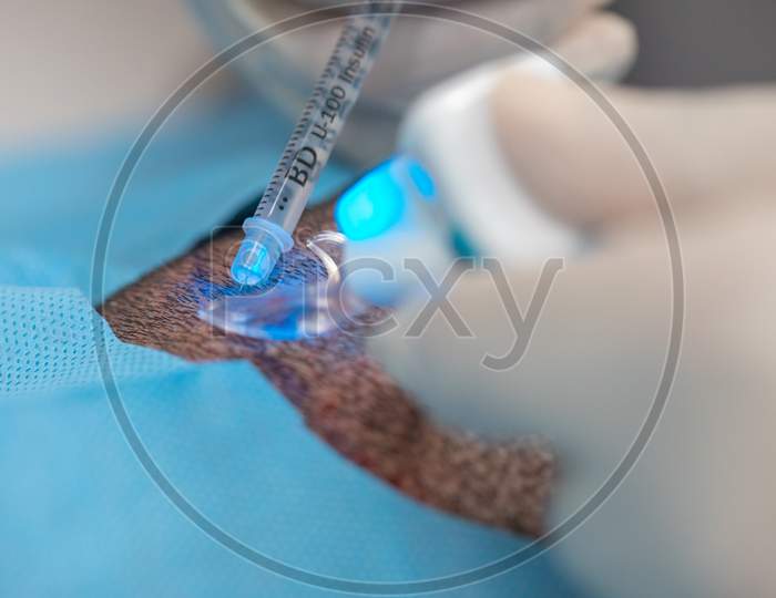 Hair Implantation Process, Injecting Anestesia In Scalp