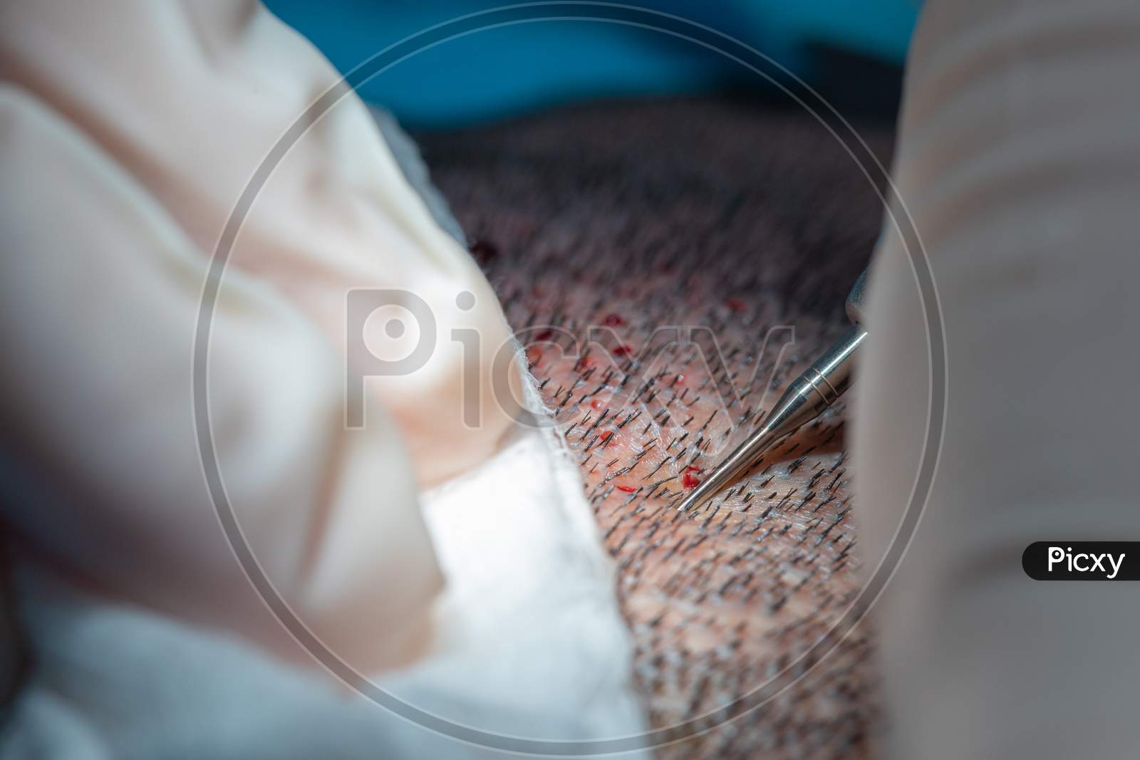 Hair Implantation Process, Closeup View Of Scalp, Hair Seeding