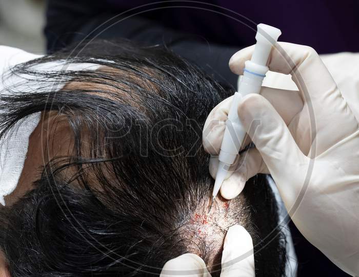 Hair,Transplantation,Process,,Pulling,Hair,Follicles,Back,And,Replanting,Them.