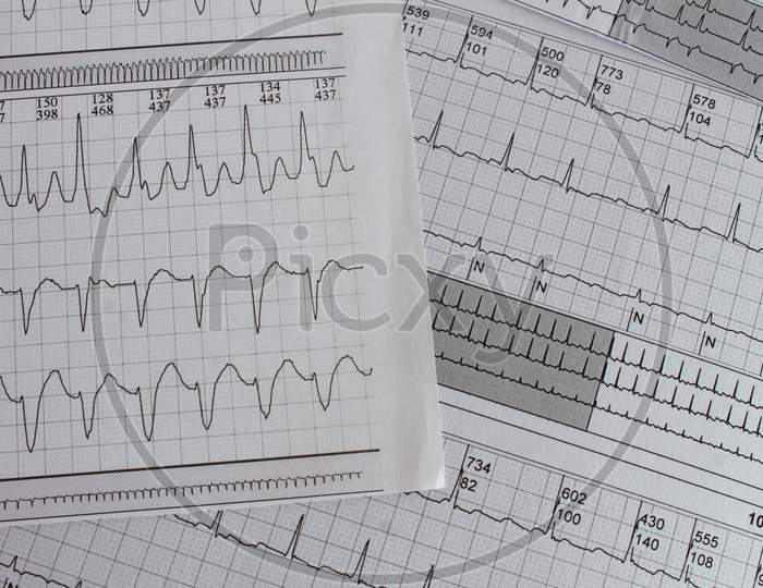 Electrocardiogram With Cardiac Arrhythmia. Patient With Atrial Fibrillation And Atrial Flutter.