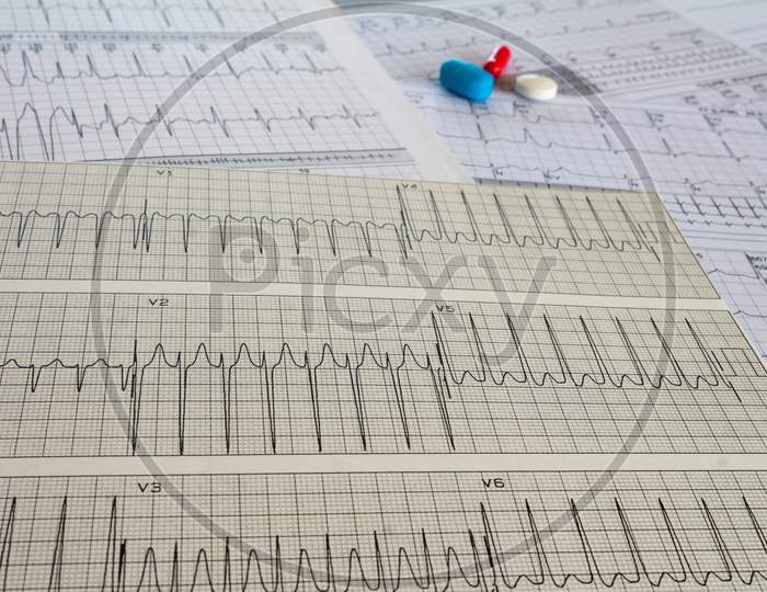 Electrocardiogram With Cardiac Arrhythmia. Medications For Arrhythmia Treatments.