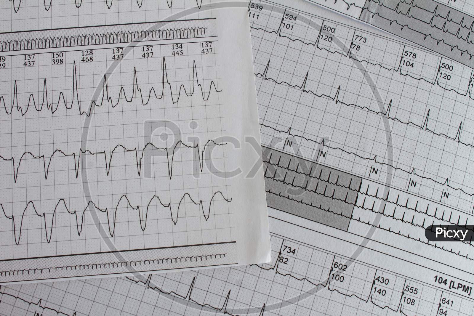 Electrocardiogram With Cardiac Arrhythmia. Patient With Atrial Fibrillation And Atrial Flutter.