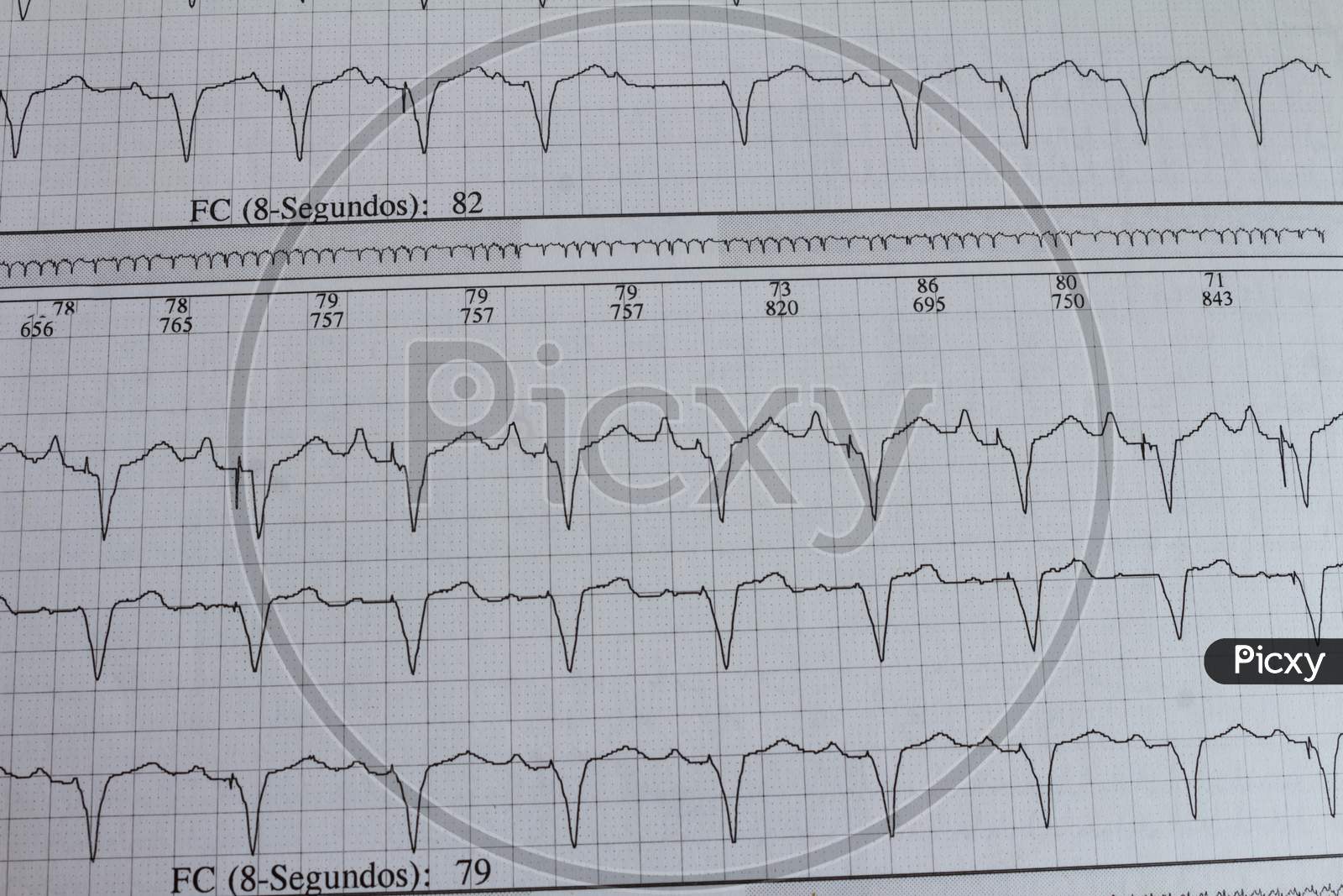 Electrocardiogram With Cardiac Arrhythmia. Patient With Cardiac Pacemaker