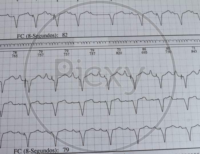 Electrocardiogram With Cardiac Arrhythmia. Patient With Cardiac Pacemaker