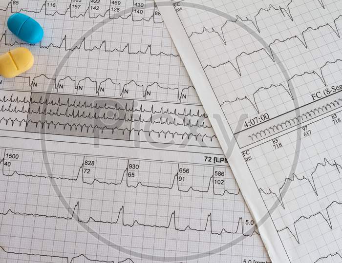 Electrocardiogram With Cardiac Arrhythmia. Medications For Arrhythmia Treatments.