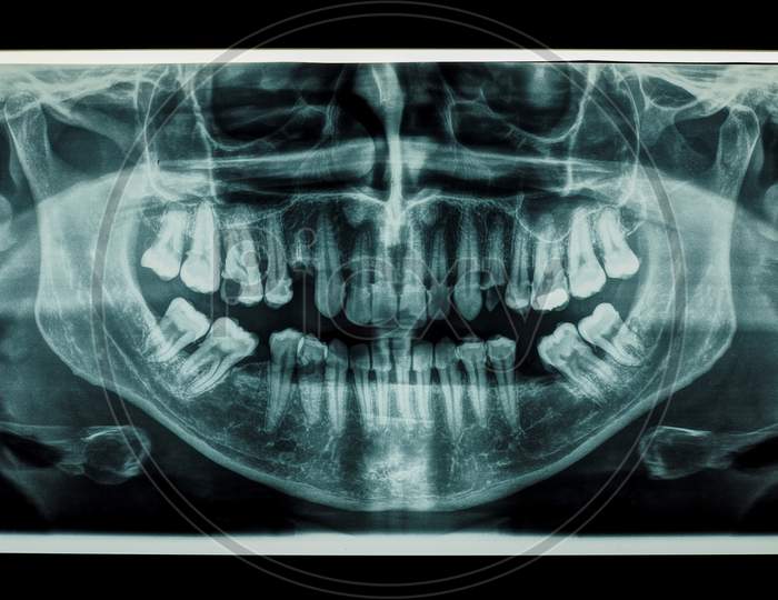 Teeth Panoramic Xray