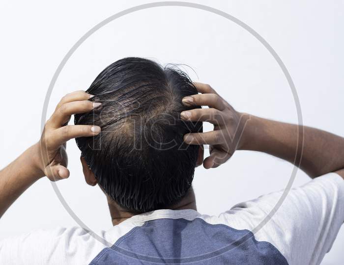 Hair Fall Problem For Men