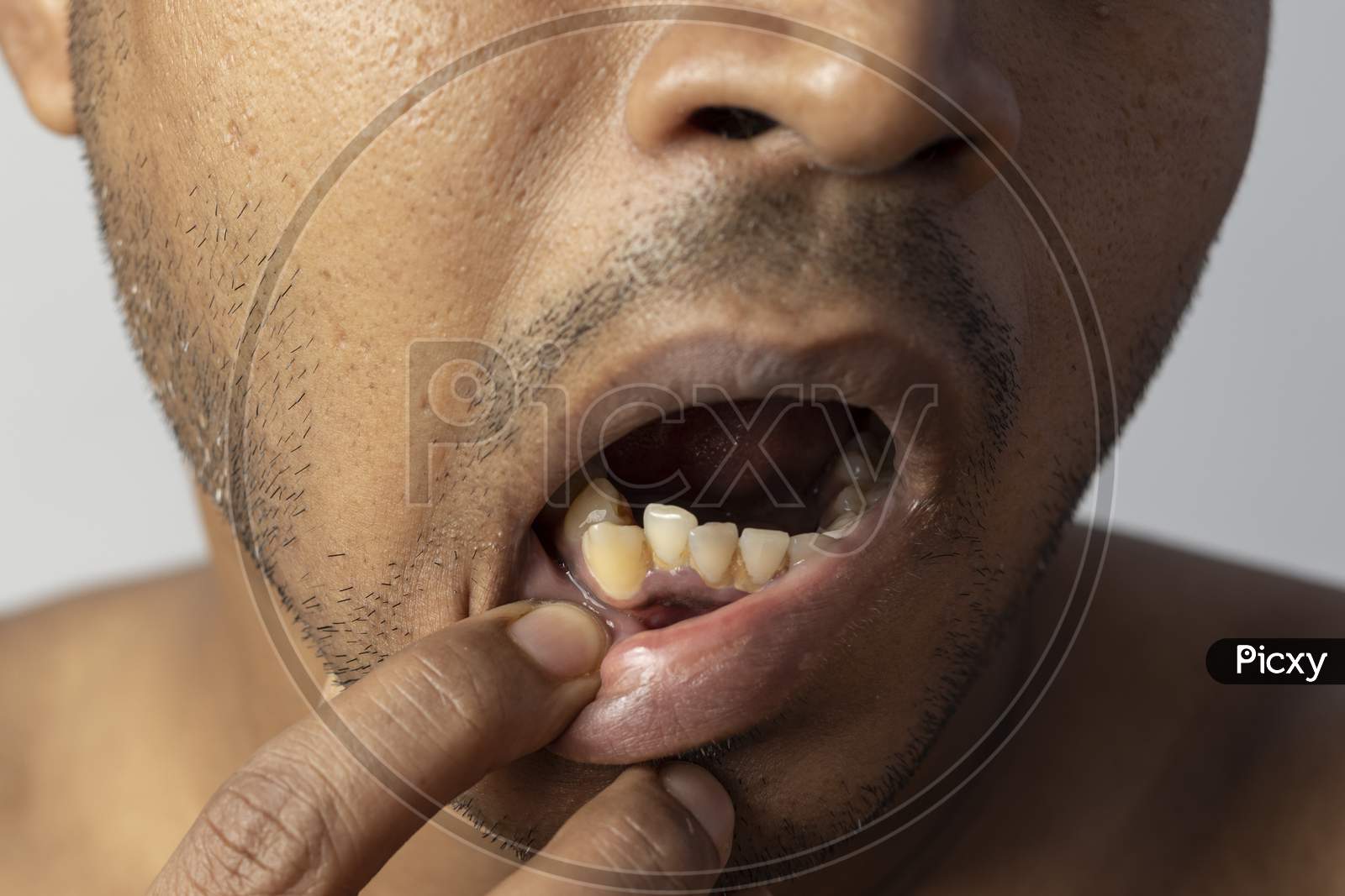 Irregular Teeth