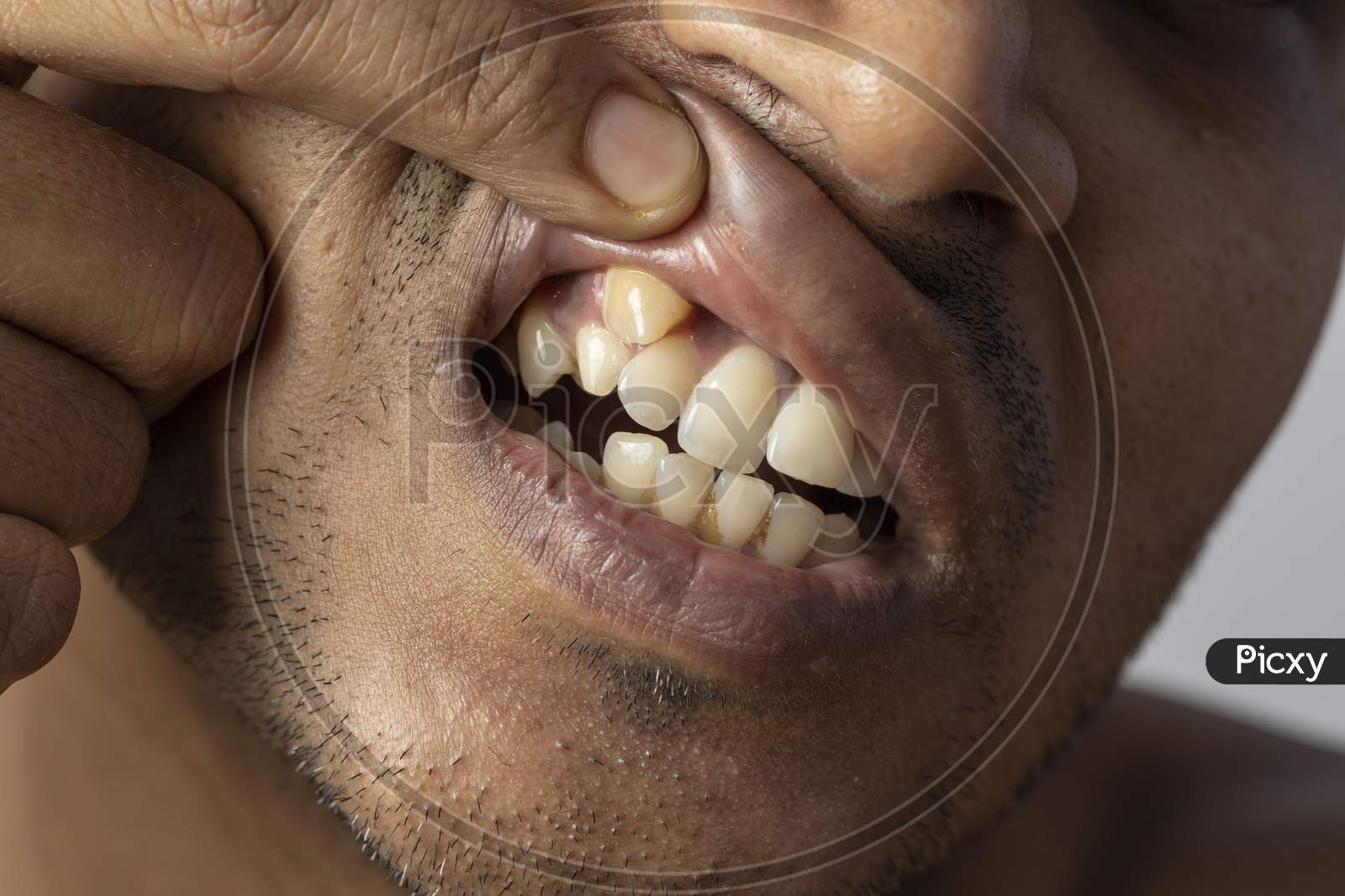 Irregular Teeth