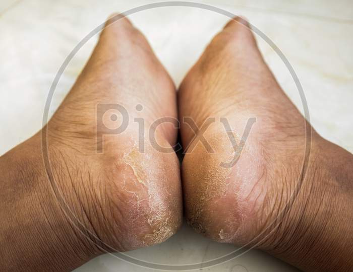 Dirty Cracked heels, South Asian man feet. Close-up. Dry skin, health problems, need for pedicure