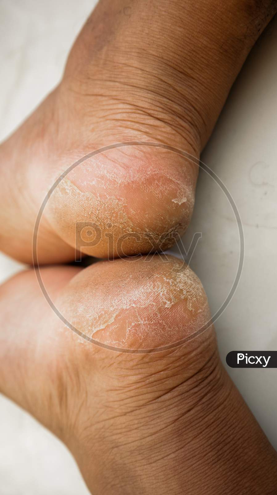 Dry Skin On Feet | And 3 Tips To Fix