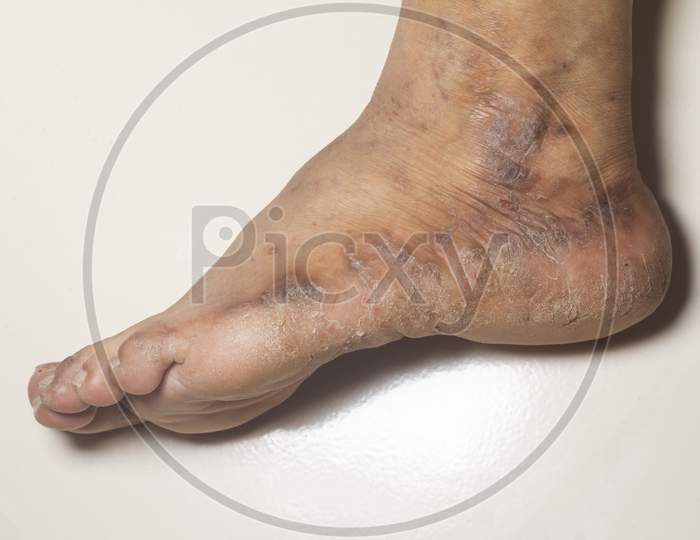 Closeup Of The Legs Of A Woman Suffering From Chronic Psoriasis On A White Background. Closeup Of Rash And Scaling On The Patient'S Skin. Dermatological Problems. Dry Skin.