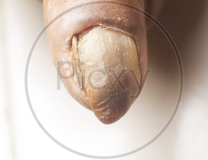 Fungus Infection On Nails Of Old Woman'S Thumb.