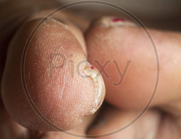 Close Up Of Foot Thumb Nail Stock Photo
