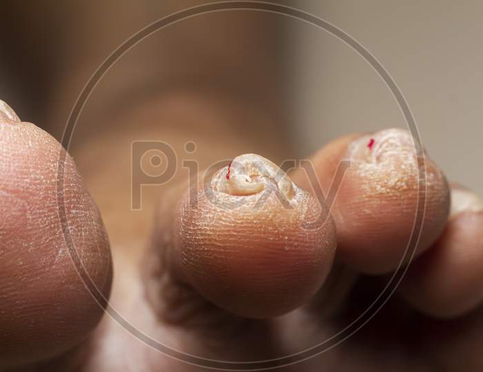 Close Up Of Foot Finger Nail Stock Photo.