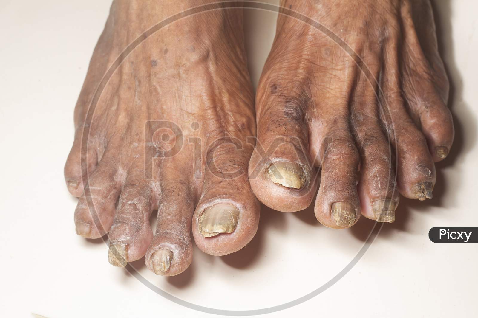 Fungus Infection On Nails Of Old Woman'S Foot